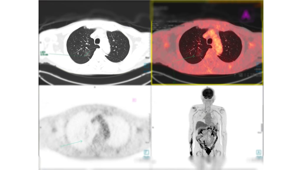 PET scans of lungs and upper body.