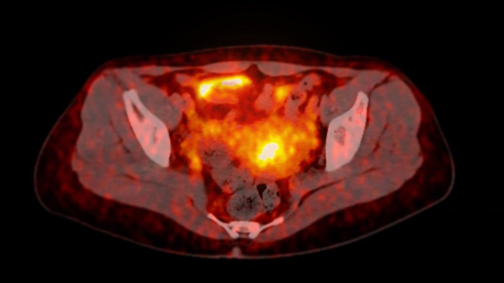 PET scan of pelvic region showing radiotracer uptake.